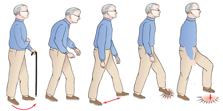 Illustration of an older adult walking with exaggerated high steps, progressing from using a cane to stepping unaided